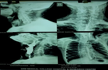 barium-swallow