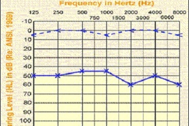 Conductive HL Audiogram