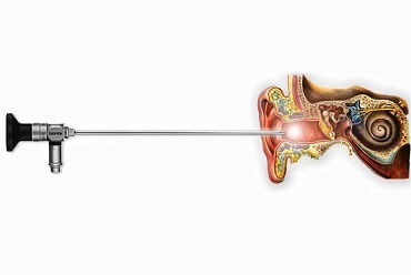Endoscopic Ear Visualisation