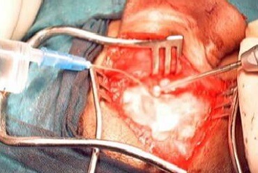 Mastoidectomy 2