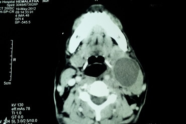Neck Abscess