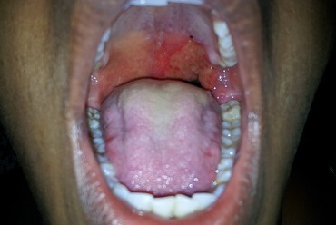 Palatal Ulcer