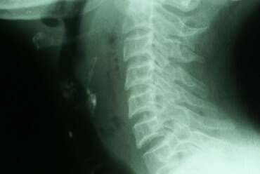 Retropharyngeal Abscess