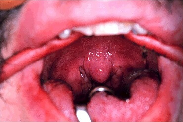 Tonsillitis